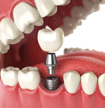 Implanturi dentare într-o clinică avansată ImplantologieBalti