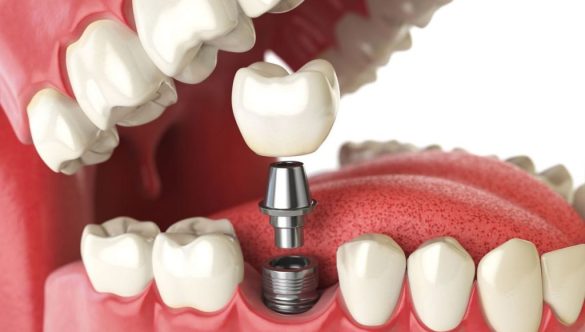 Implanturi dentare într-o clinică avansată ImplantologieBalti