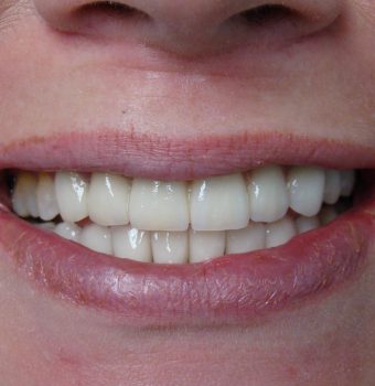 Necesitatea unei proceduri de protezare dentară