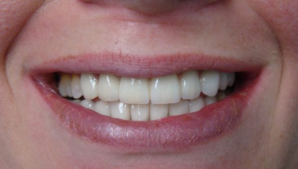 Necesitatea unei proceduri de protezare dentară