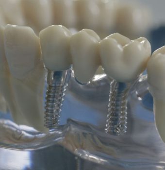 De ce să alegeți implanturi dentare de înaltă calitate în Chișinău