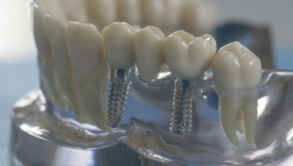 De ce să alegeți implanturi dentare de înaltă calitate în Chișinău