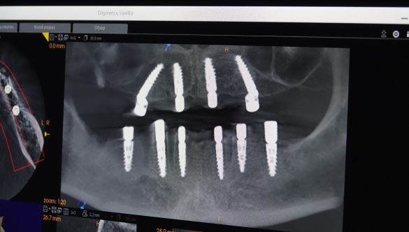 Implanturile dentare la implant.md: Soluția modernă pentru o dantură completă