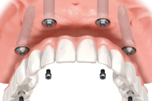 Tipuri de implanturi dentare: Clasificare și caracteristici la implant.md