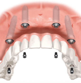 Tipuri de implanturi dentare: Clasificare și caracteristici la implant.md