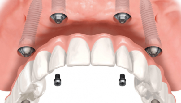 Tipuri de implanturi dentare: Clasificare și caracteristici la implant.md