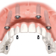 Tipuri de implanturi dentare: Clasificare și caracteristici la implant.md