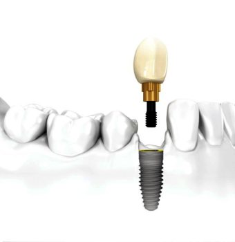 Implantul dentar unitar: Soluția ideală pentru înlocuirea unui singur dinte