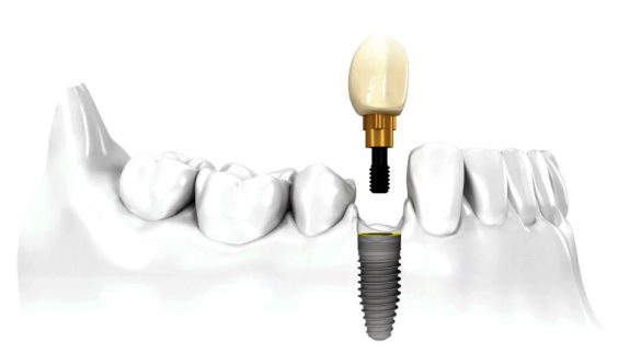 Implantul dentar unitar: Soluția ideală pentru înlocuirea unui singur dinte