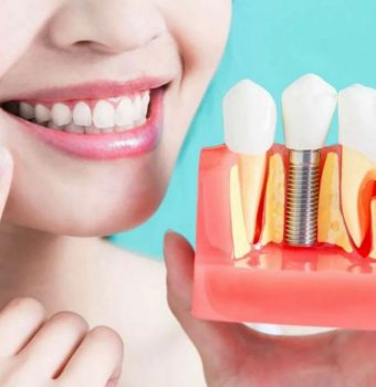 De ce implantul dentar este cea mai sigură și estetică soluție de protezare?