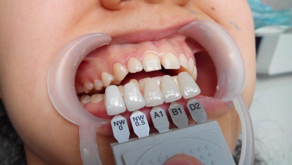Indicații pentru implantul dentar: când este necesară reabilitarea orală?