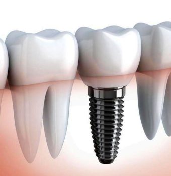 Prețuri pentru implanturi dentare „la cheie” la clinica implant.md din Bălți