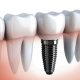 Prețuri pentru implanturi dentare „la cheie” la clinica implant.md din Bălți