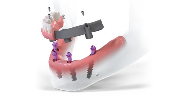 Reabilitarea orală totală: Protocoalele All-on-4 și All-on-6 la implant.md în Bălți