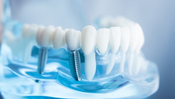 Implant dentar în Bălți: Calitate, precizie și soluții personalizate