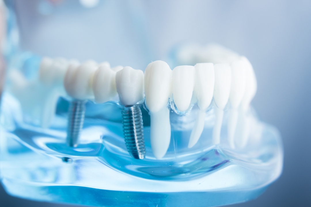 Implant dentar în Bălți: Calitate, precizie și soluții personalizate